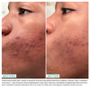 Woman's skin before and after using USRX Clear Complexion Acne Serum + Spot Treatment