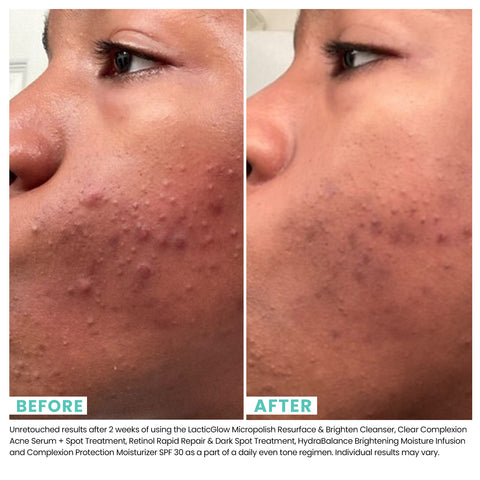 Woman's skin before and after using USRX Clear Complexion Acne Serum + Spot Treatment