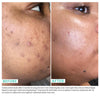 Woman's skin before and after using USRX Even Tone Super Glow Serum