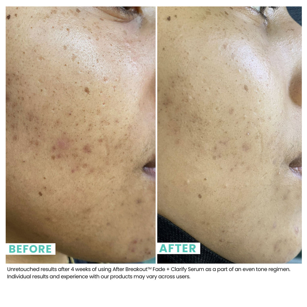 Comparison of skin before woman uses Urban Skin RX After Breakout Treatment Fade & Clarify Serum and after using it, with visibly clearer skin