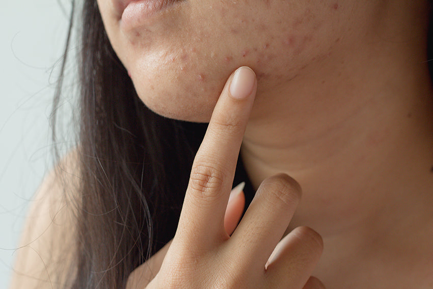 woman with chin acne