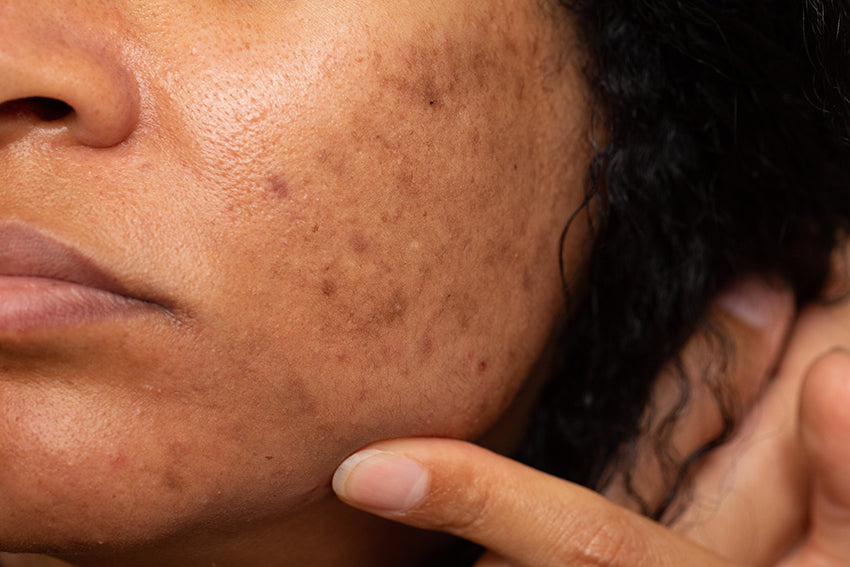 woman with dark spots or hyperpigmentation