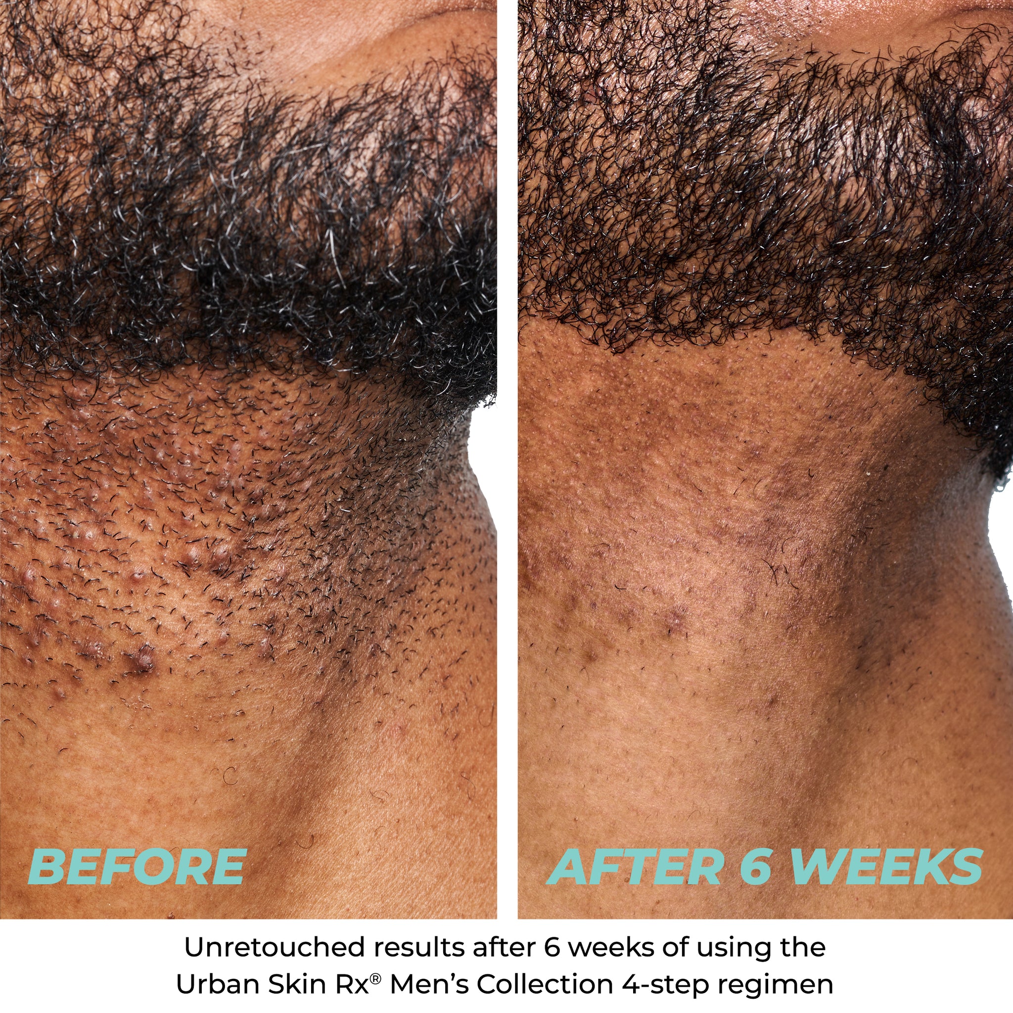 Comparison of skin before using Urban Skin RX Urban Skin RX Razor Bump + Dark Spot Treatment to his face and after using it